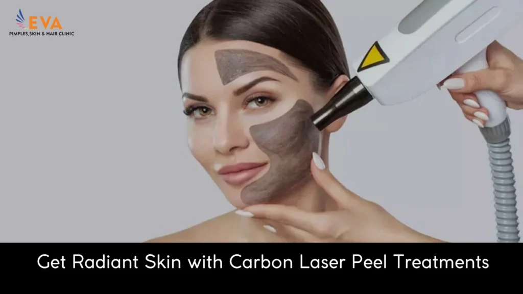 Carbon Laser Peel Treatment