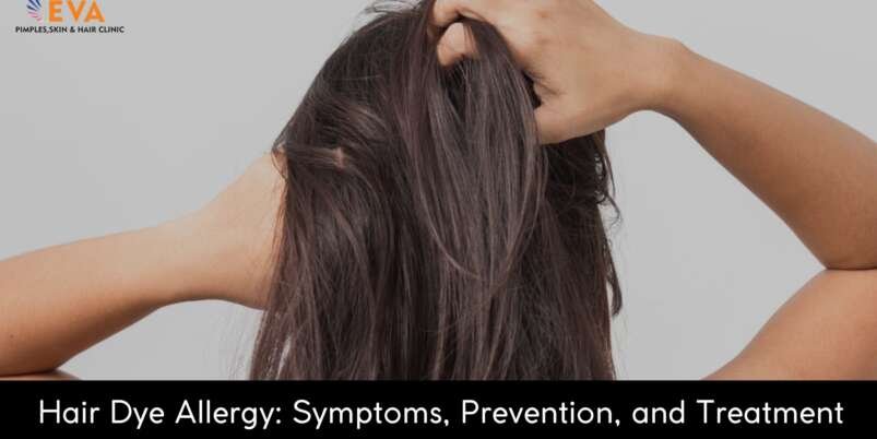 Hair-Dye-Allergy-Symptoms-Prevention-and-Treatment-Banner