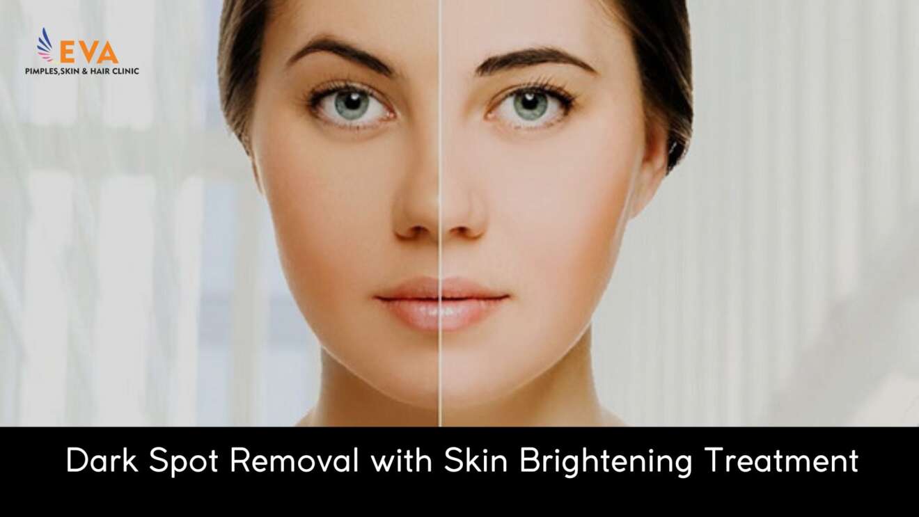 Skin Brightening Treatment for Dark Spots