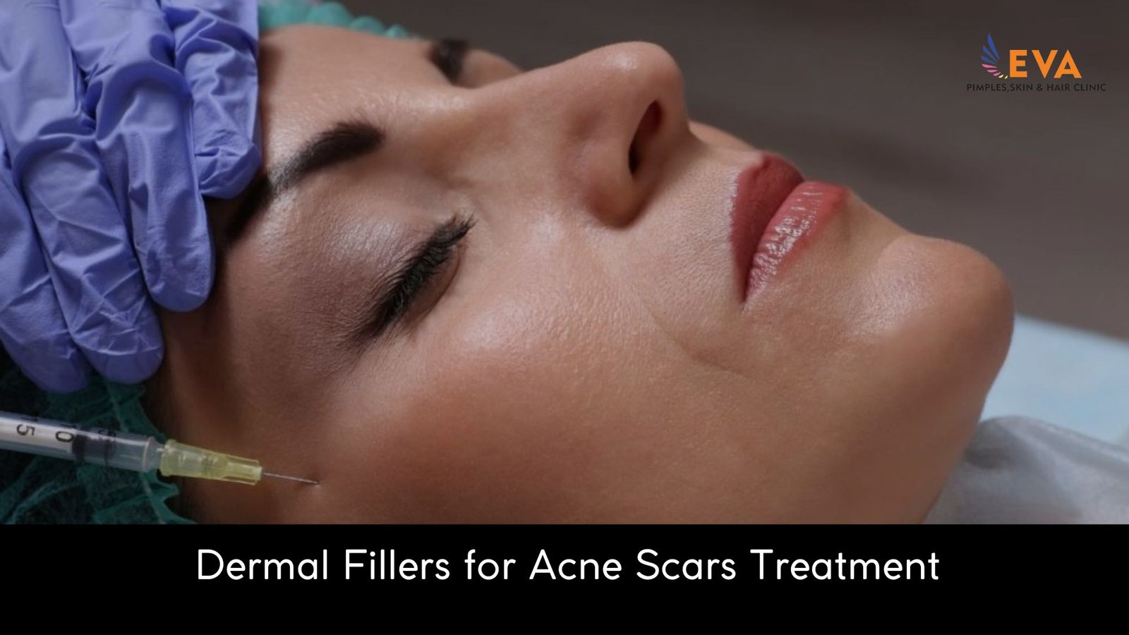 Dermal Roller and Fillers for Acne Scars Treatment in Pune - EVA Skin Clinic