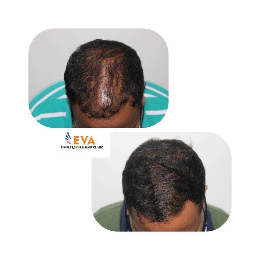 Hair Loss Treatment Result
