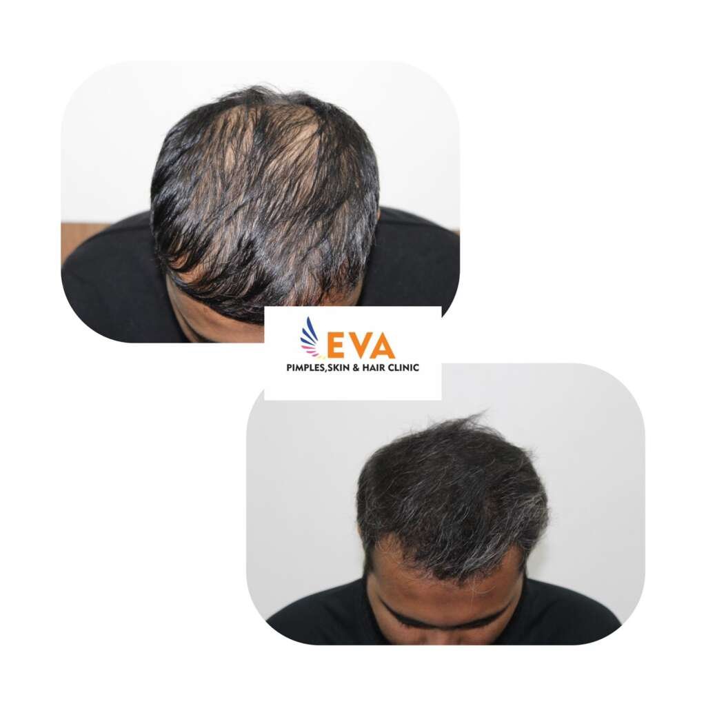 Hair Loss Treatment Result - EVA Skin Clinic Pune