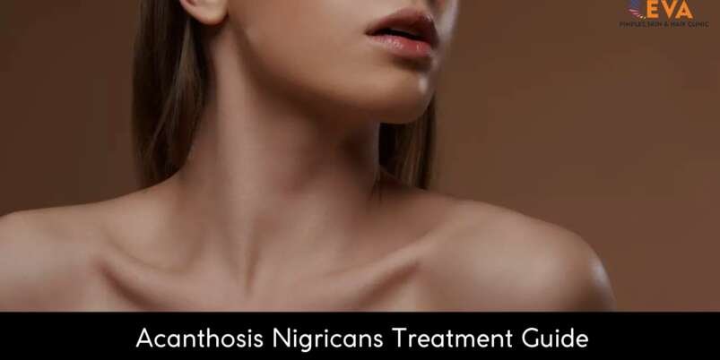 Acanthosis-Nigricans-Treatment-Banner