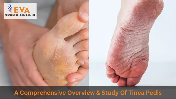 tinea pedis