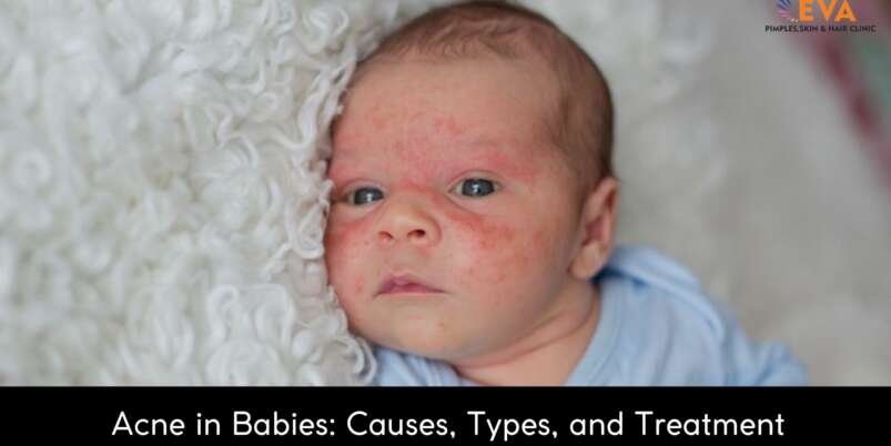 Acne-in-Babies-Banner