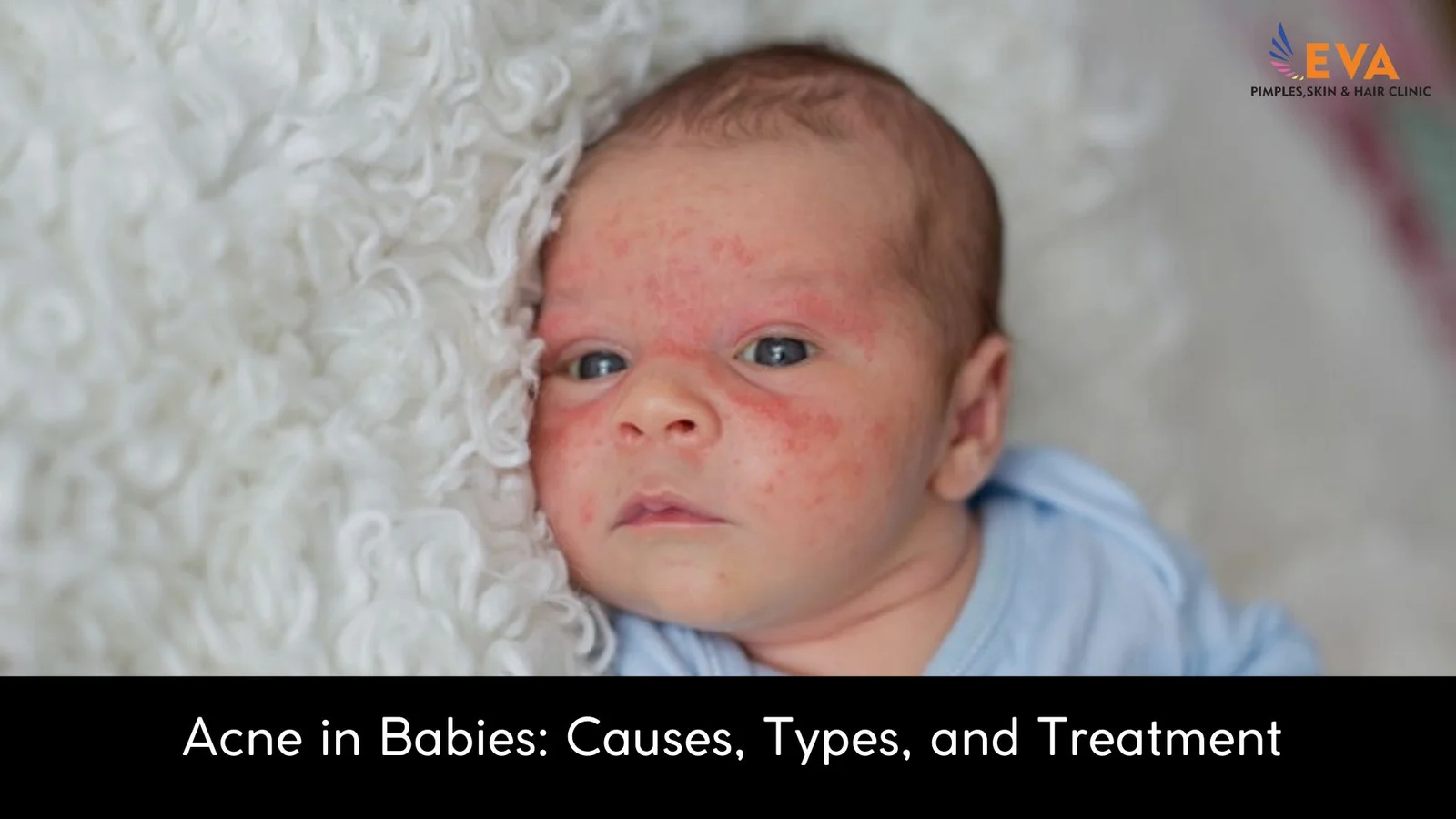 Acne-in-Babies