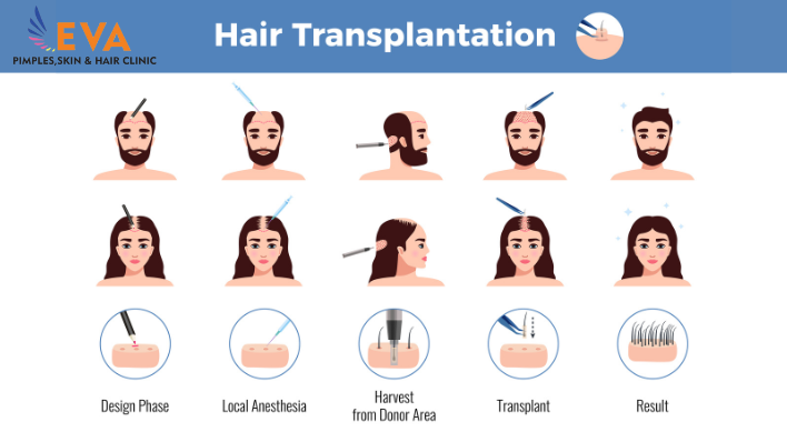 Demystifying the Process How Hair Transplants Work - A Comprehensive Guide