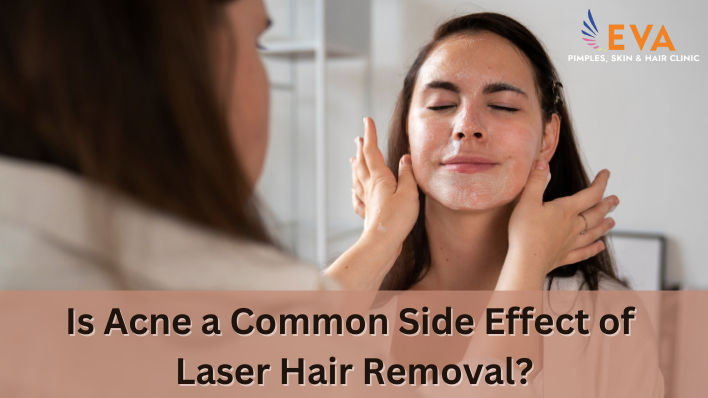 Is Acne a Common Side Effect of Laser Hair Removal?