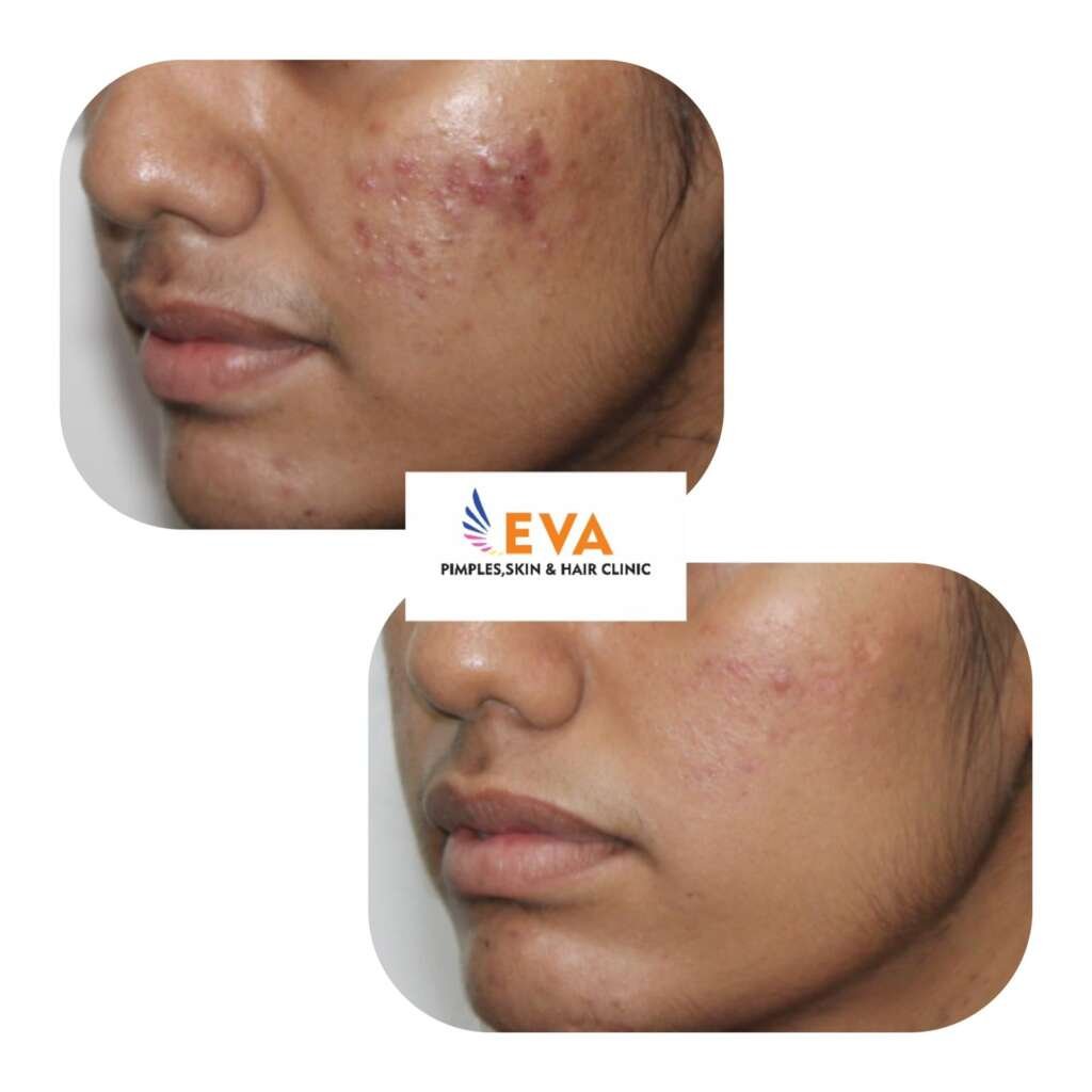 Acne-before-and-after