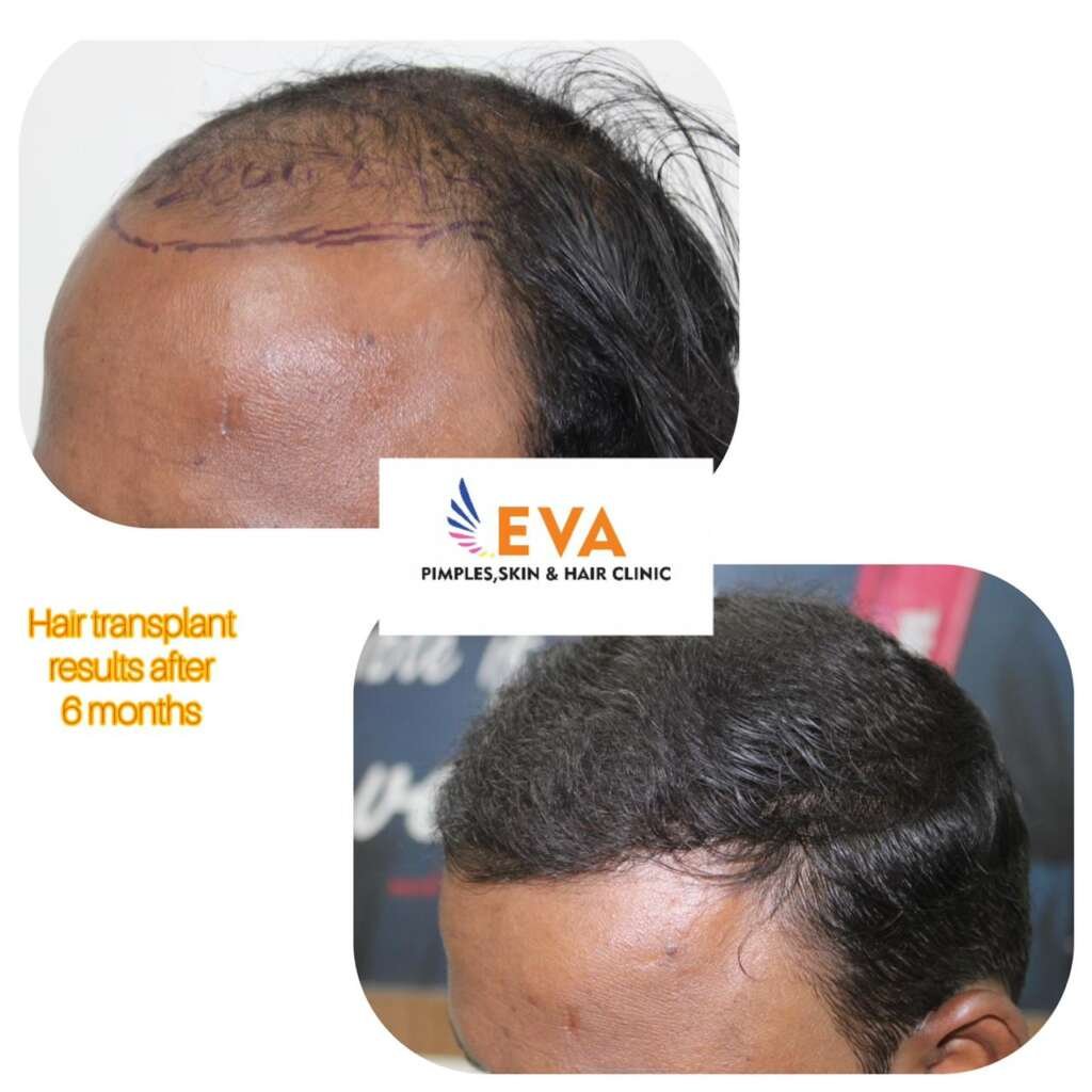 Hair-Transplant-Before-and-After