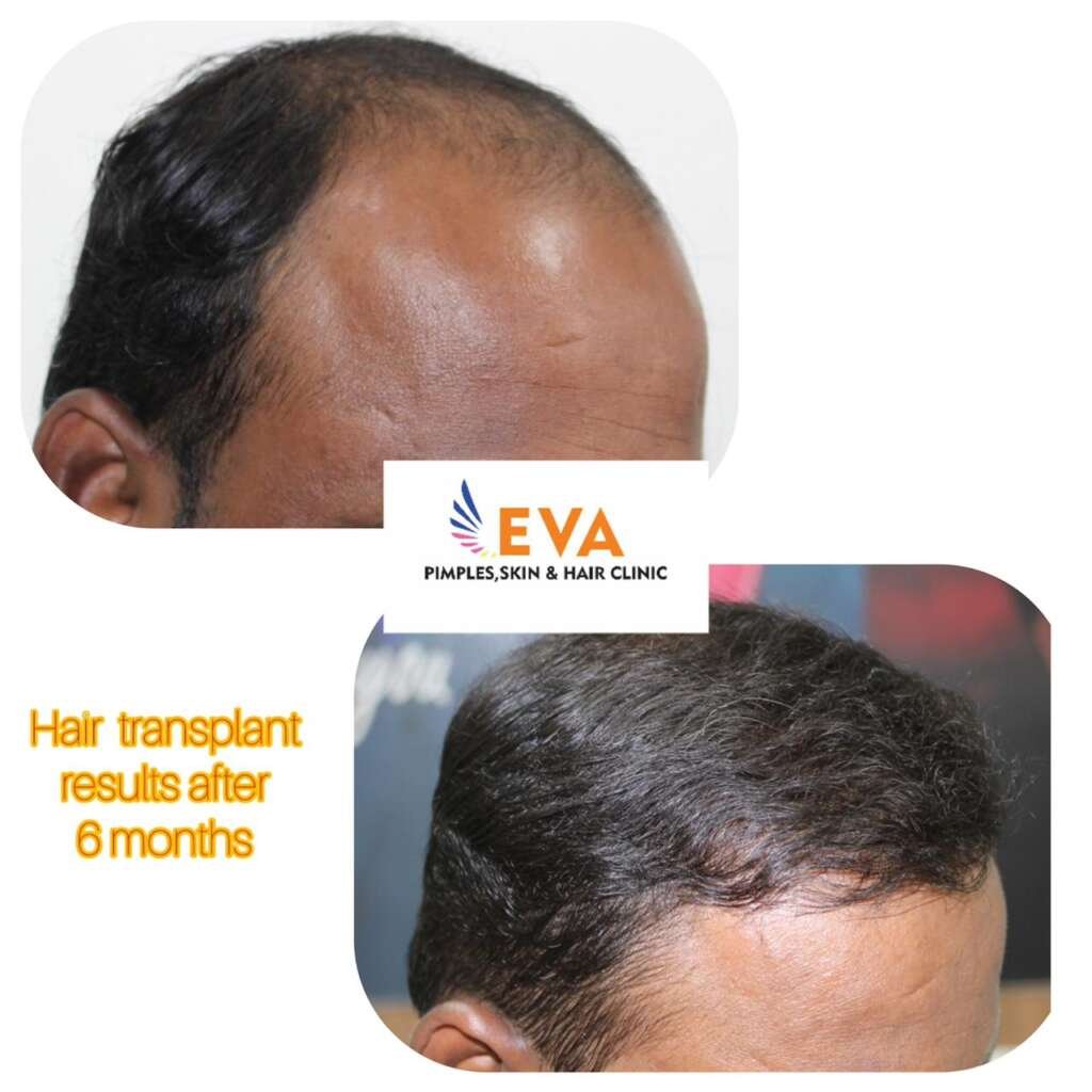 Hair-Transplant-Before-and-After