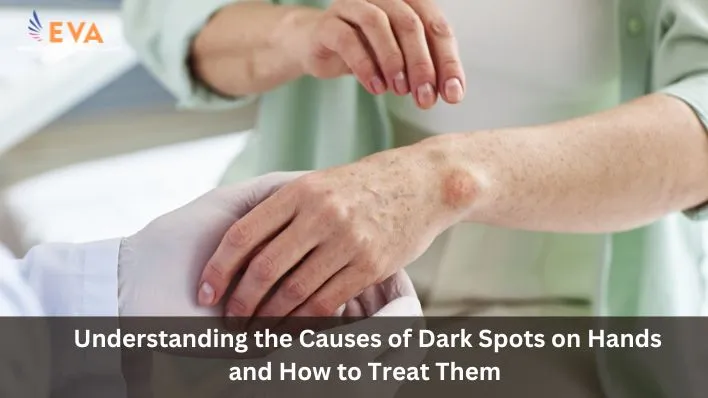 Understanding the Causes of Dark Spots on Hands and How to Treat Them