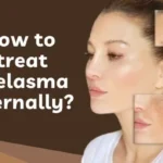 melasma