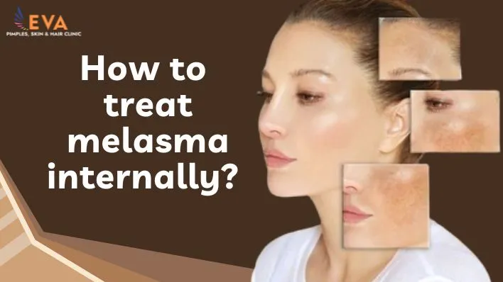 How to treat melasma internally