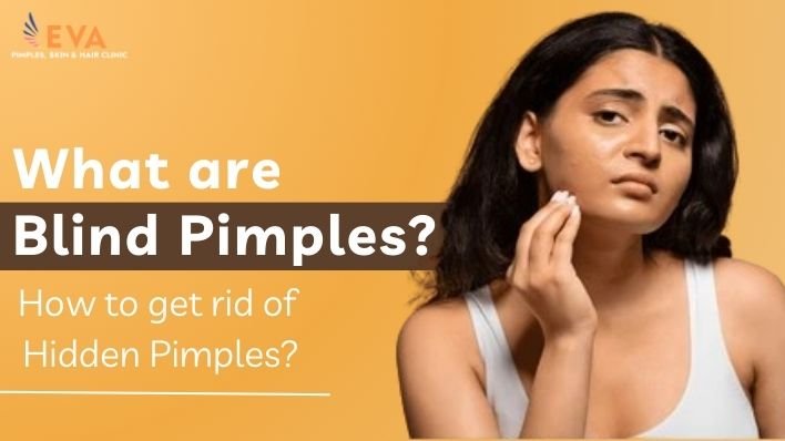What are Blind Pimples and How to Get Rid of Hidden Pimples?