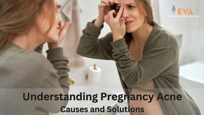 Understanding Pregnancy Acne Causes and Solutions