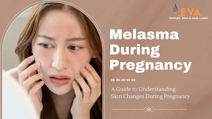 All You Need to Know About Melasma During Pregnancy