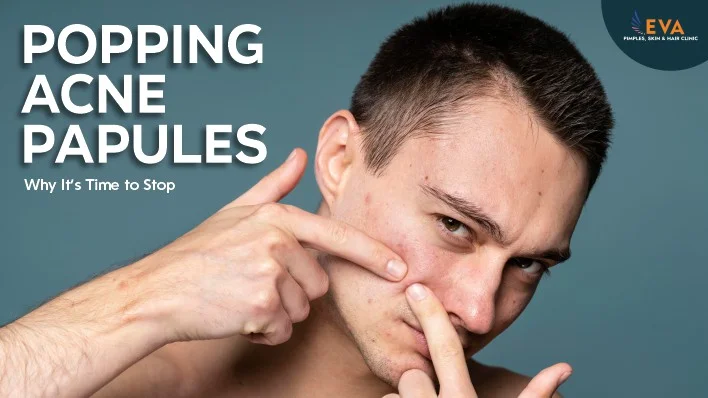 acne papules