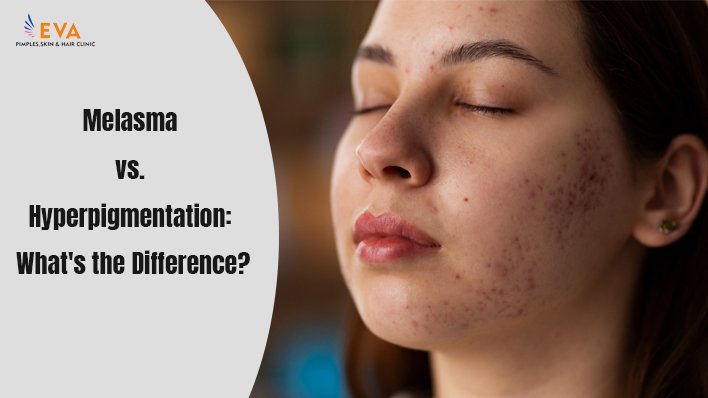 Melasma vs. Hyperpigmentation What's the Difference