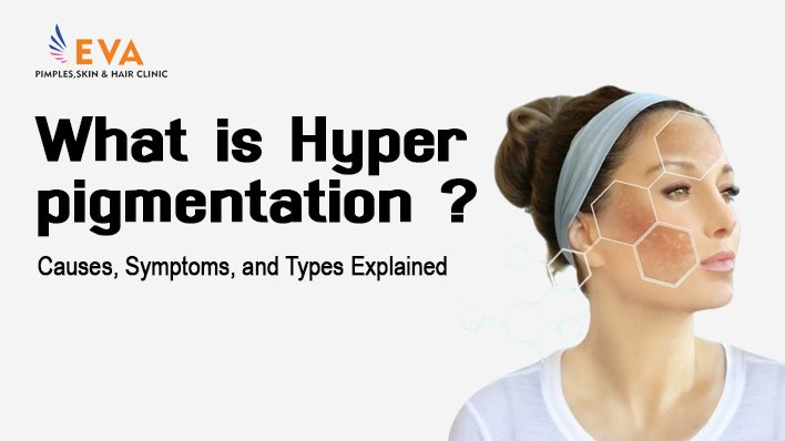 What is Hyperpigmentation? Causes, Symptoms, and Types Explained