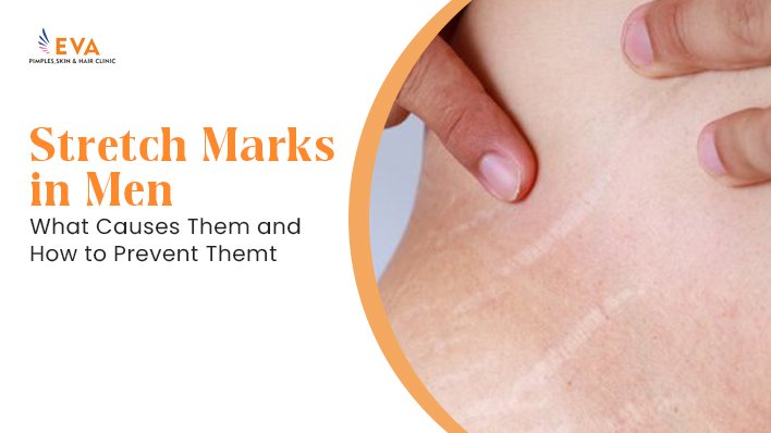 Stretch Marks in Men: What Causes Them and How to Prevent Them?