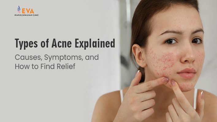 Types of Acne Explained Causes, Symptoms, and How to Find Relief