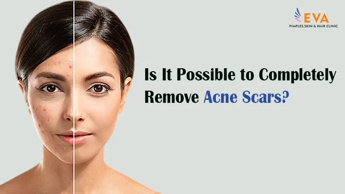 acne scars