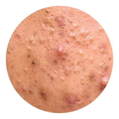 Acne Types 3
