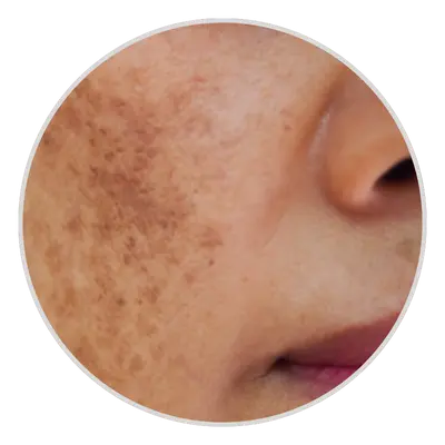 Epidermal-Melasma