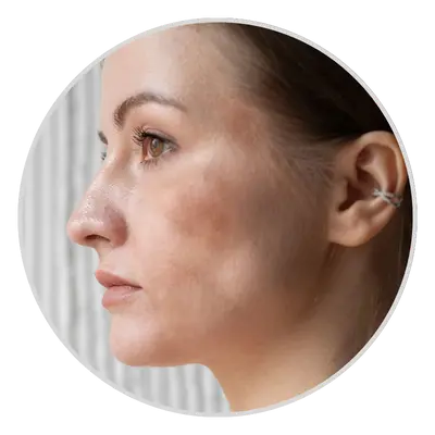 Dermal Melasma