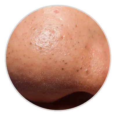 blackheads