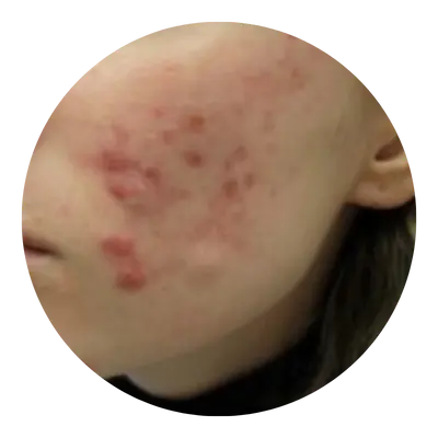 Acne Types 2