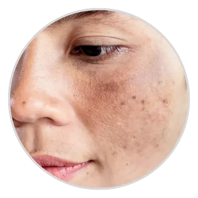 Mixed-Melasma