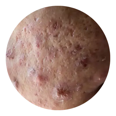 Acne Types 1