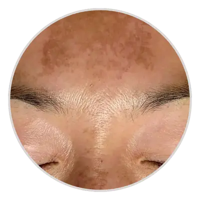 Centrofacial-melasma