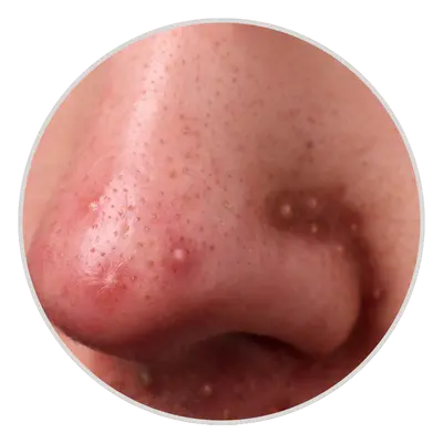 4.pustules