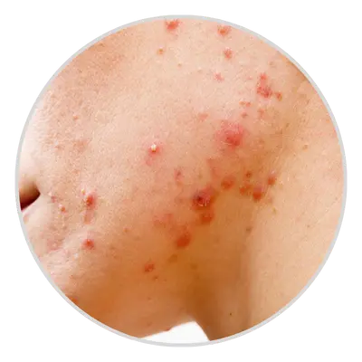 nodules-acne