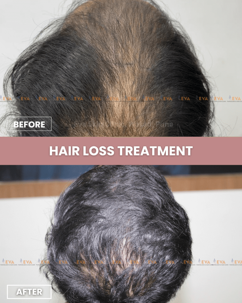 Hair loss treatment results