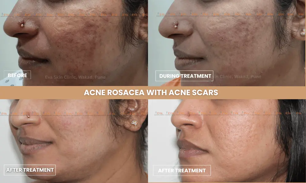 ACNE-with-acne-scars