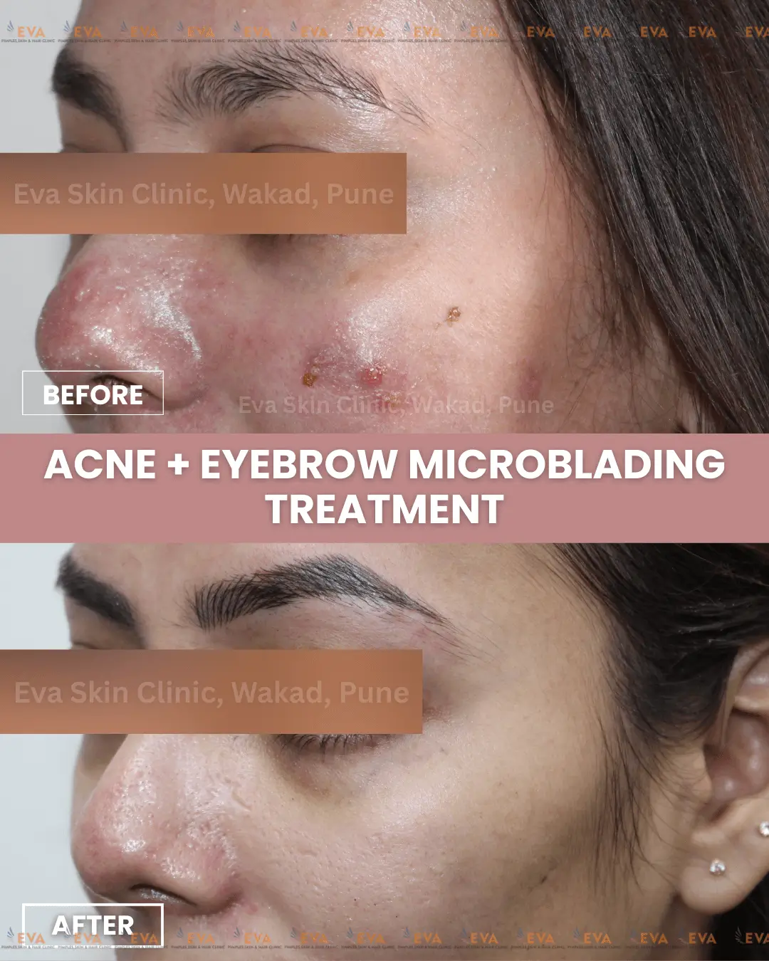 Acne-Before-After-results