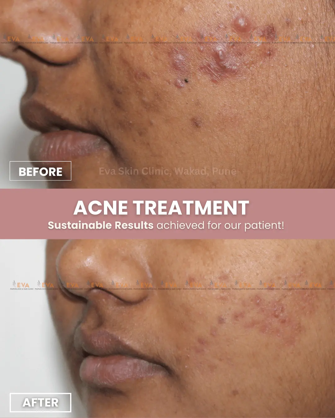 Acne-Before-After