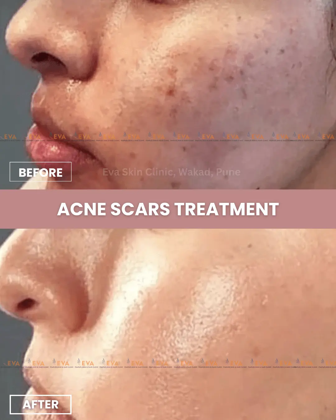 Acne-scars-before-after-results