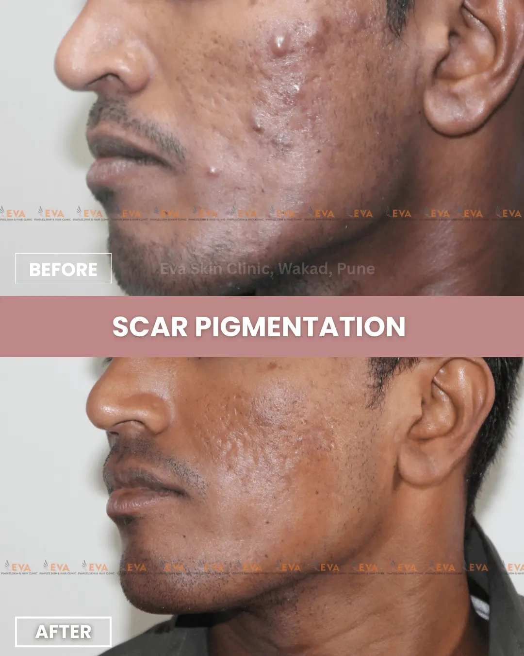 Acne-scars-before-after