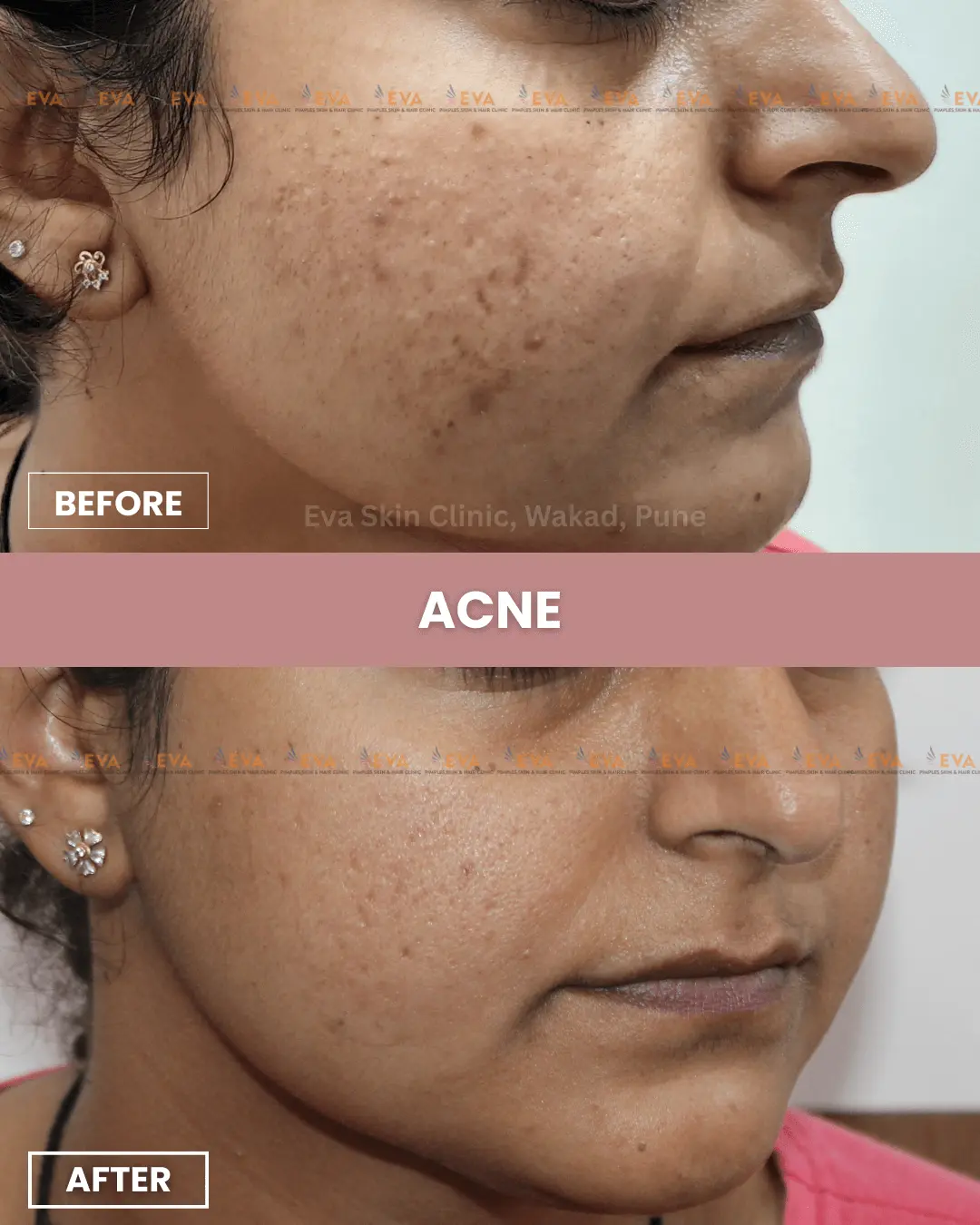 Best-acne-treatment-in-pune