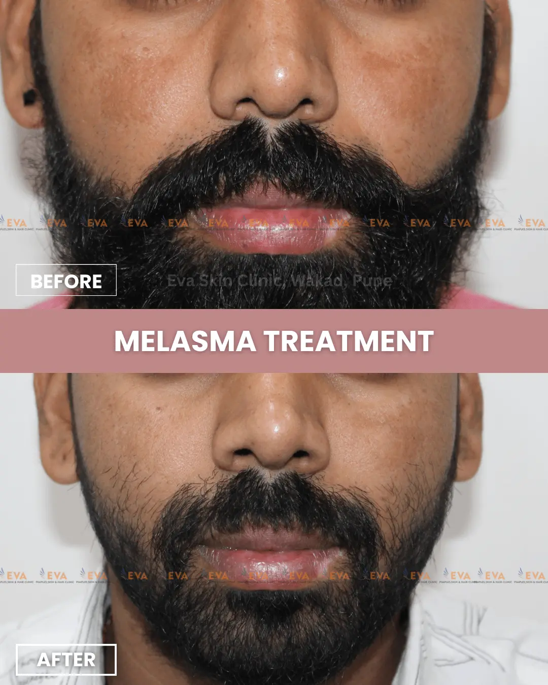 Best-melasma-before-after-results
