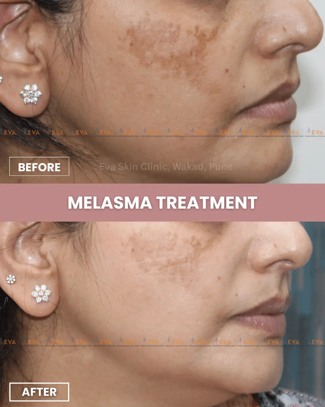 Best-melasma-results