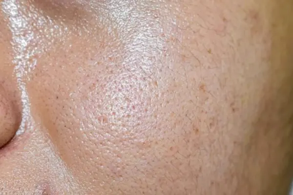Excess-Sebum -Production