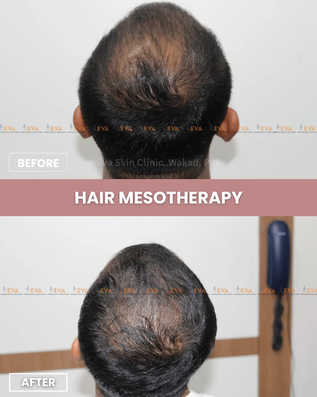 Hair-loss-before-after-results