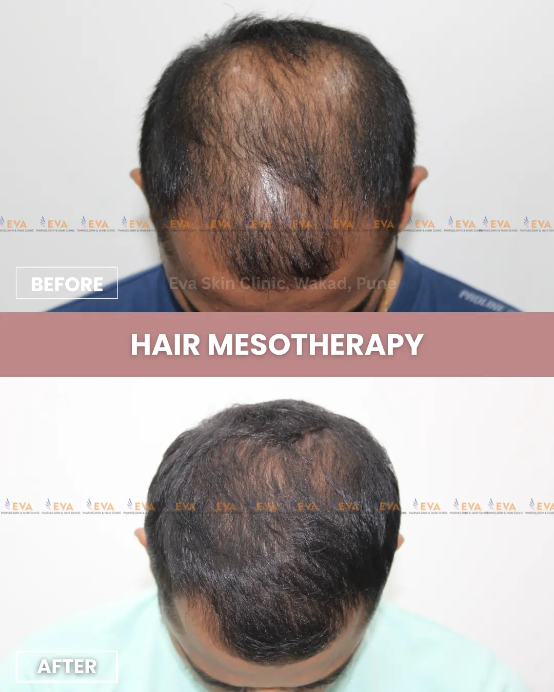 Hair-loss-before-after