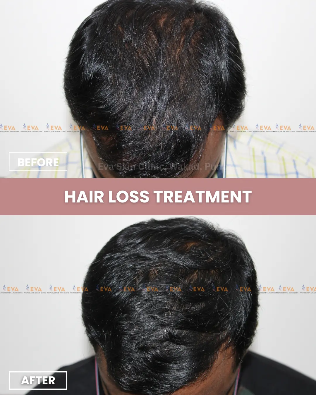 Hair-loss-results